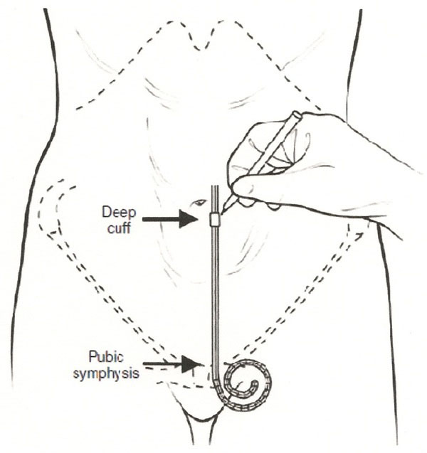 peritoneal dialysis catheter insertion