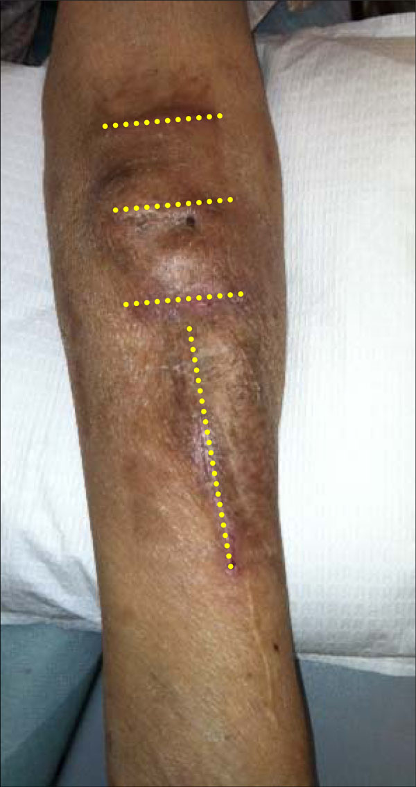 Aneurysmal Dilatation Of Dialysis Arteriovenous Access